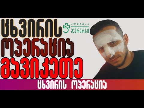 ცხვირის ოპერაცია გავიკეთე, რა შედეგებით დასრულდა ოპერაცია?