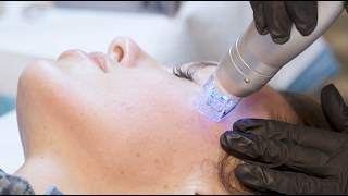 How the Scarlet SRF Microneedling Device Became This Practice’s Top Revenue Generator in 12 Months