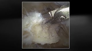 Posterior Ankle Nano Arthroscopy Using the NanoNeedle™ Scope 2.0 and NanoResection™ Devices