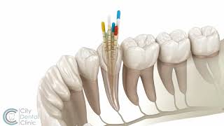 Endodontics | Root canal treatment | City Dental Clinic Bratislava screenshot 1