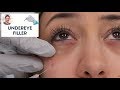 Undereye Filler By Leif Rogers, MD, FACS | Fanning Technique | Beverly Hills