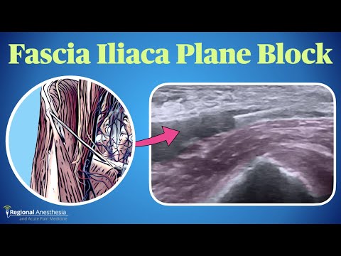 Fascia Iliaca Plane Block