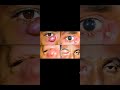 Acute Dacryocystitis( आंसुओं की थैली में संक्रमण)infection in nasolacrimalSacAwerenes of All@#viral