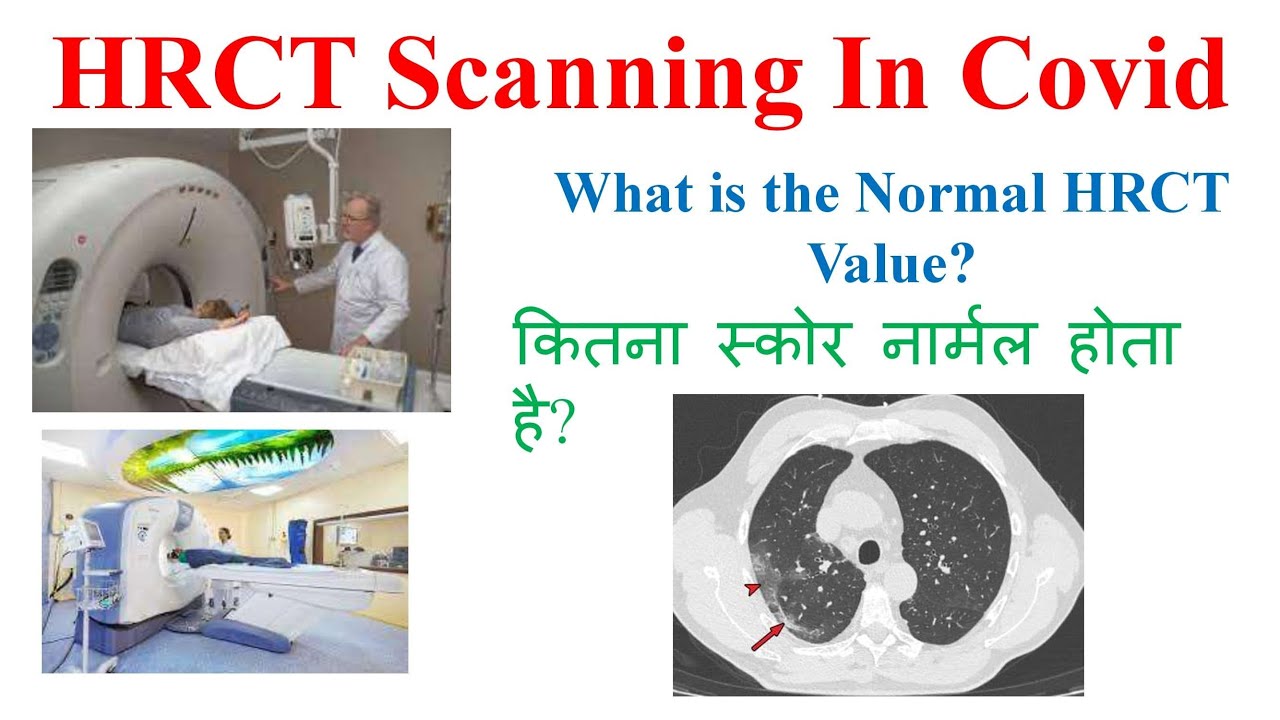 HRCT Hindi Me COVID 19 HRCT HRCT Of COVID Patient hrct-hindi-me-covid-19-hrct-hrct-of-covid-patient