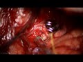 Microsurgical Clipping of an Unruptured Early MCA Bifurcation Aneurysm
