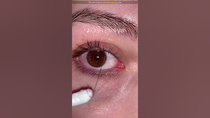 When does this happen in the eyes?