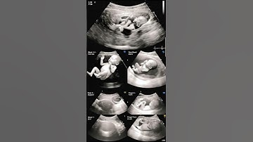 Fetal Development (2 to 12 Weeks) | Real Ultrasound Pregnancy Scan #pregnant #ultrasound #baby