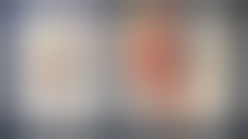 Microsurgical Clipping of a Recurrent Coiled and Flow-Diverted Basilar Bifurcation Aneurysm