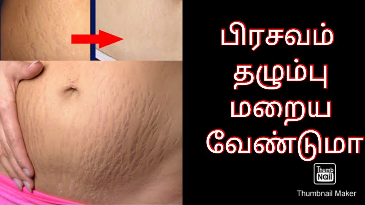 விரைவில் பிரசவ தழும்புகள் மறைய After Pregnancy Stretch Marks Removal