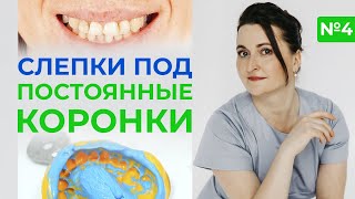 Протезирование зубов / Как делаются слепки зубов под постоянные коронки?