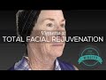 69 yo female total facial rejuvenation  an amazing transformation  aesthetic minutes facelift