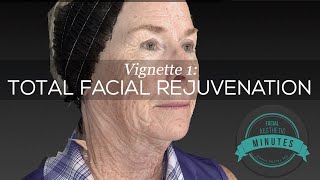69 yo Female Total Facial Rejuvenation - An Amazing Transformation | Aesthetic Minutes #Facelift