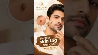 Fast & Painless Skin Tag Removal Procedure in India | Advanced Skin Care Clinic | FUE India