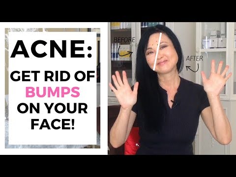Acne - GET RID OF BUMPS ON THE FACE