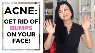 Acne - GET RID OF BUMPS ON THE FACE