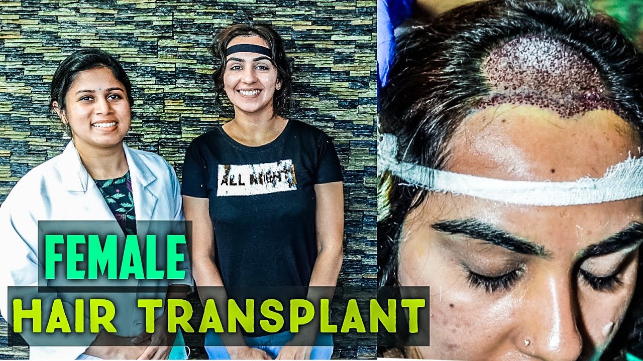 Female Hair Transplant ഹയർ ടരൻസപലനറ സതരകൾകക  Hair O Dent  DrAthira Sreenath  YouTube