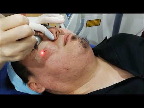 Fotona Acne Scar Treatment at Beau&Hans