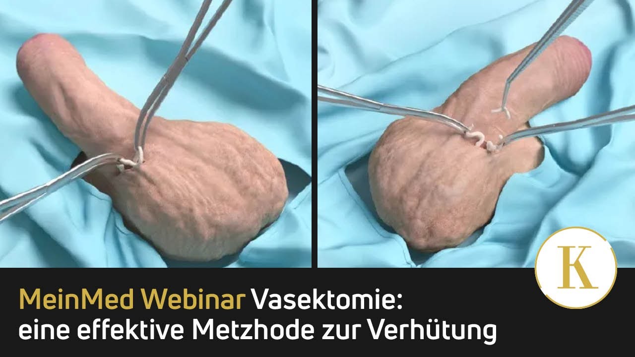 Vasektomie: Die Sterilisation beim Mann als eine effektive Methode zur Verhtung Vasektomie: Die Sterilisation beim Mann als eine effektive Methode zur Verhtung