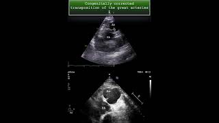 Congenitally corrected transposition of the great arteries 5