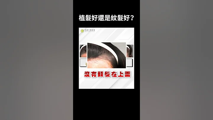 頭髮稀疏 該植髮還是紋髮？｜毛爵生髮診所 - 天天要聞