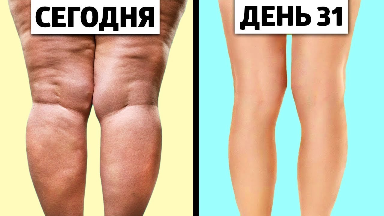 Как Навсегда ИЗБАВИТЬСЯ ОТ ЦЕЛЛЮЛИТА Быстро *рабочие способы* - YouTube