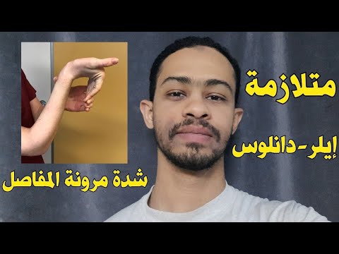 متلازمة ايرلز دانلوس مرونة المفاصل الزائدة اسباب اعراض تشخيص علاج