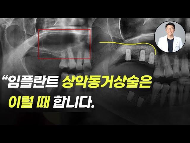 임플란트 상악동거상술이란 무엇이고, 언제 하는 건가요?