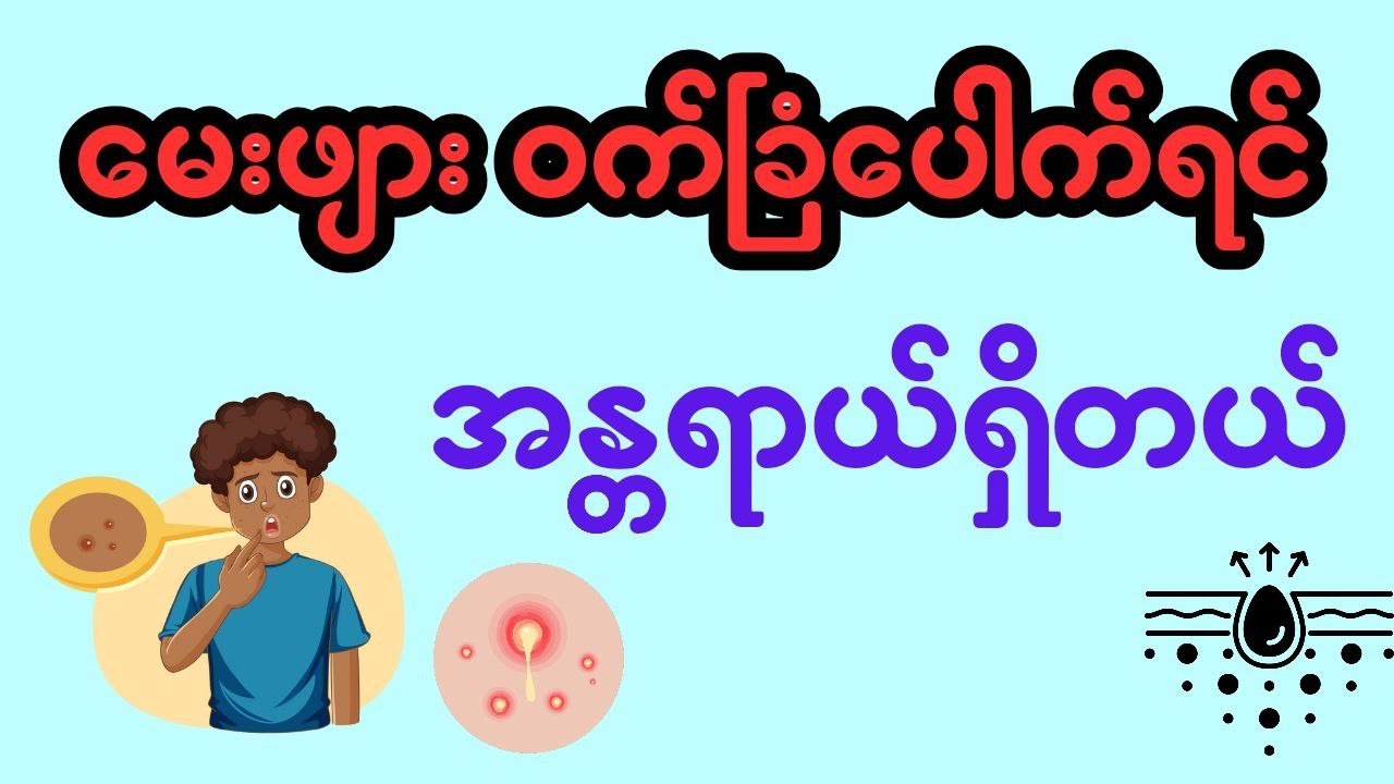 မေးဖျား ဝက်ခြံပေါက်ရင် အန္တရာယ်ရှိတယ် ??? - Acne