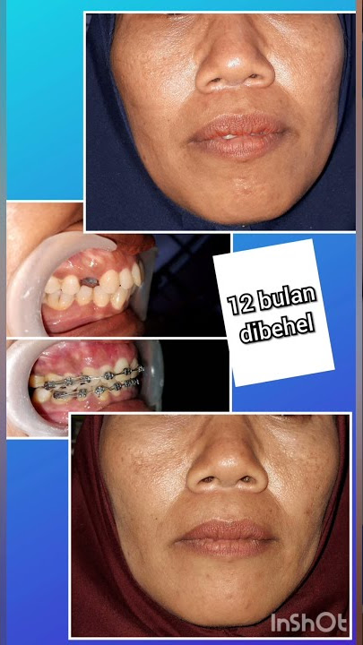12 bulan perawatan behel gigi maju pada usia hampir40 tahun