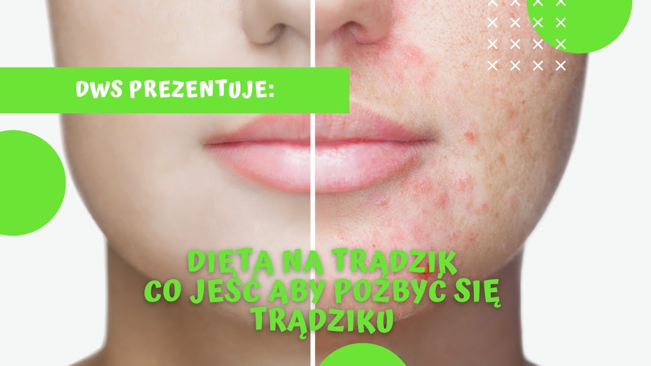 Dieta na trądzik - jak pozbyć się trądziku? Nabiał. Jakie jedzenie powoduje trądzik? 