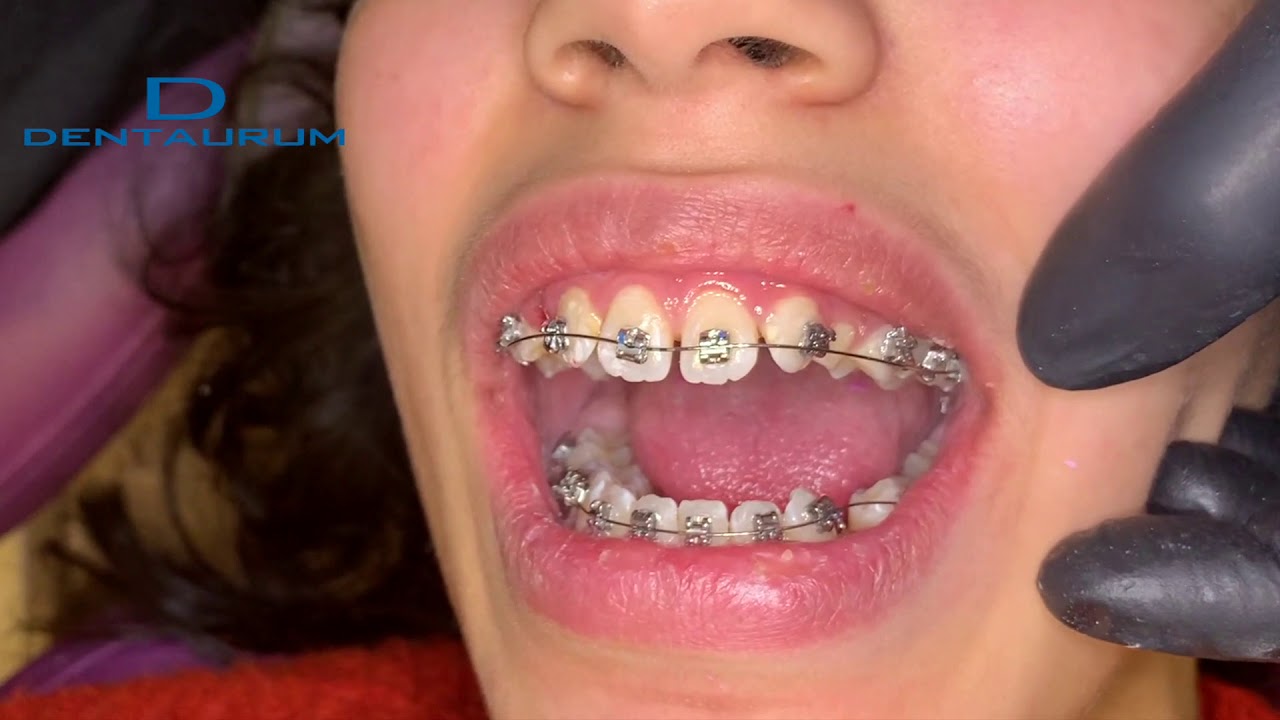 FF003. Dinamique self ligating metal brackets from Dentaurum / Wire ...