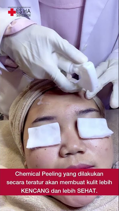 CHEMICAL PEELING - ES HA SKIN CENTER KARAWANG