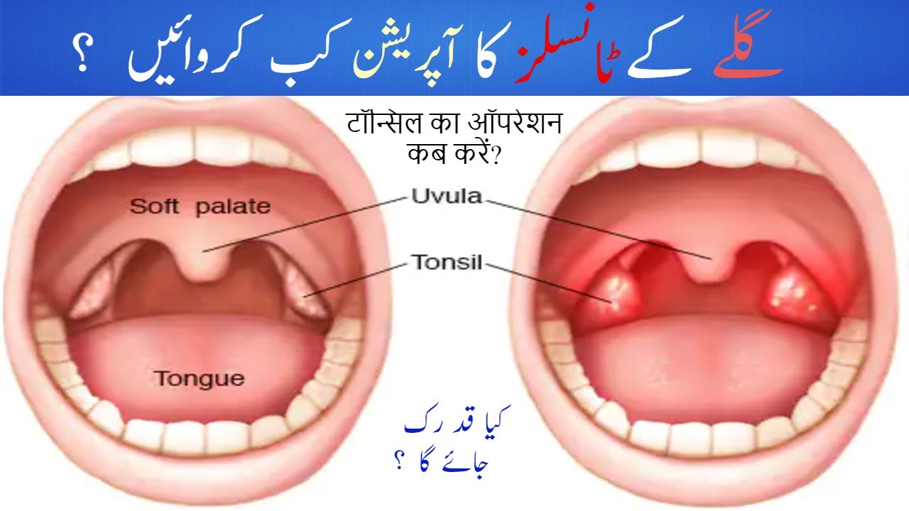 Tonsils infection ) Tonsillitis (Tonsillectomy ) / टॉन्सिल का ऑपरेशन कब