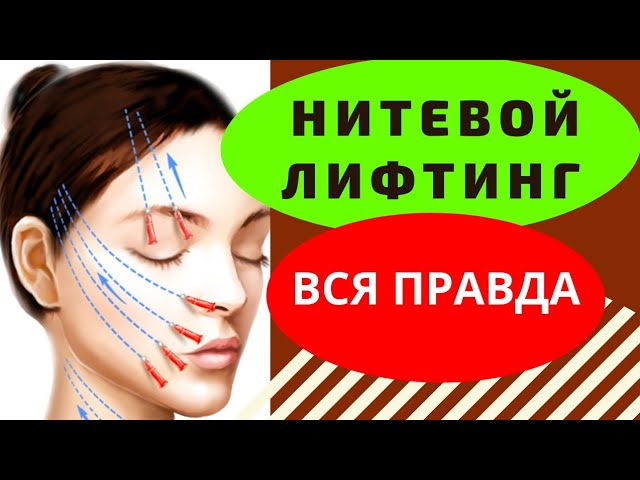 Лифтинг нитями "СИЛУЭТ СОФТ" мой опыт.