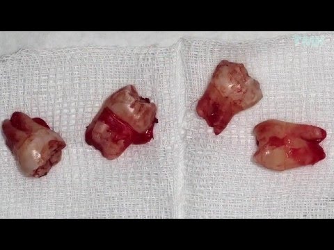 Wideo: Jak odciążyć ząb zatrzymany: 8 kroków (ze zdjęciami)