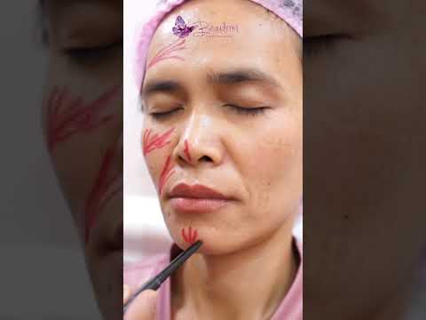 Bagian Area Pada Wajah Yang Dapat Di Filler