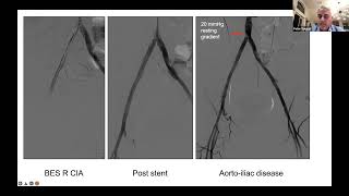 Techniques to Cross Iliac, Femoropopliteal & BTK CTOs
