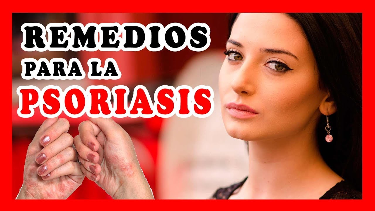Cómo tratar la psoriasis del cuero cabelludo Cómo tratar la psoriasis del cuero cabelludo