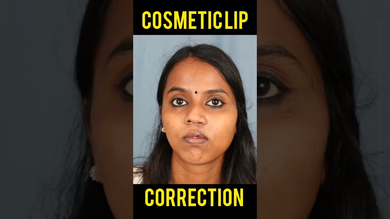 Cosmetic Lip Correction In India – Get the Perfect Lips with Lip Correction Surgery  #shorts