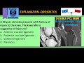 DOUBLE PCL SIGN- MRI KNEE- BUCKET HANDLE TEAR OF MEDIAL MENISCUS