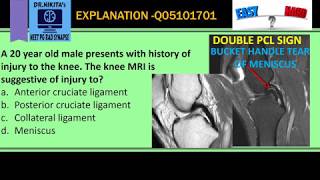 Double Pcl Sign- Mri Knee- Bucket Handle Tear Of Medial Meniscus