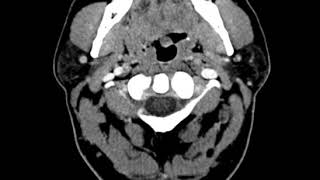 Tongue Carcinoma