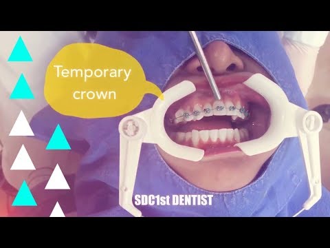 ครอบฟัน สำหรับจัดฟัน (Temporary crown for braces)