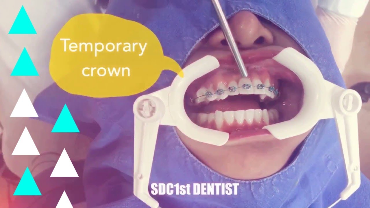 ครอบฟัน สำหรับจัดฟัน (Temporary crown for braces)