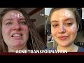 how i improved my skin - my acne story + advice