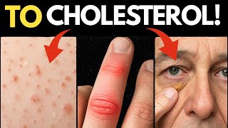 7 Sygnałów Wysokiego Cholesterolu, Które Widzisz W Lustrze