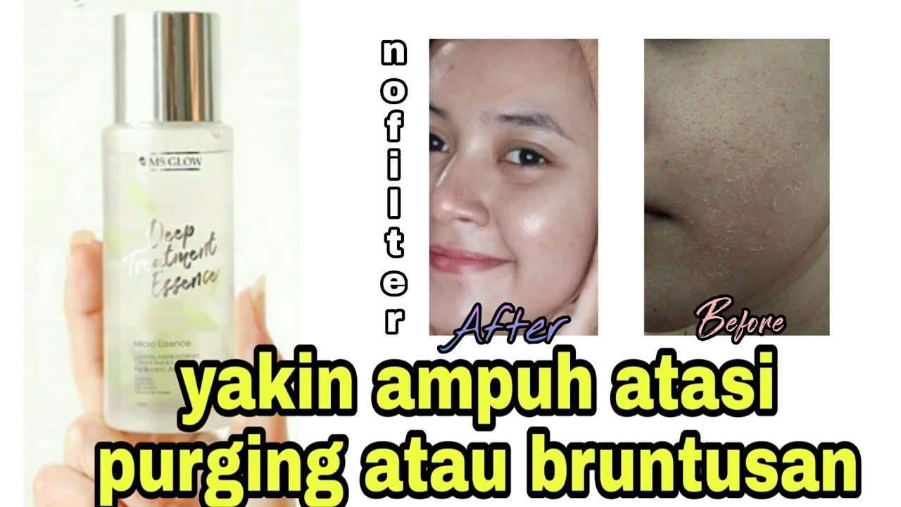 REVIEW DEEP TREATMENT ESSENSE MS GLOW // AMPUH ATASI