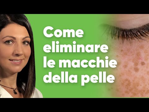 Video: 4 Modi Per Un Trattamento Efficace Delle Macchie Della Pelle