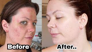 Don't Try At-Home Microneedling Until You Watch This  #microneedling #skincareroutine