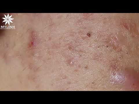 BLACKHEADS AND ACNE REMOVAL # | Nặn mụn ẩn dưới da, mụn đầu đen | 黑頭和粉刺去除 | 